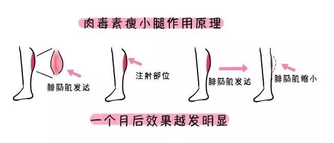 ****注射瘦腿多少钱?影响价格的因素有哪些?