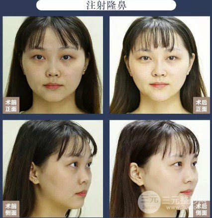 玻尿酸隆鼻成好吗