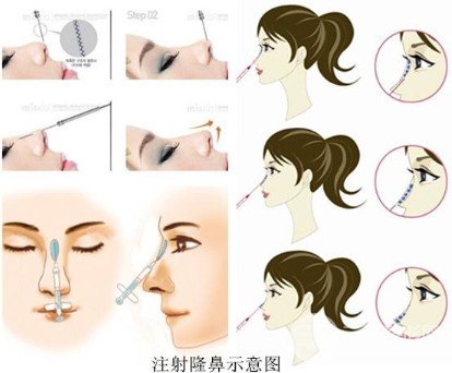 玻尿酸隆鼻成好吗