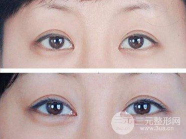 开外眼角前后对比图