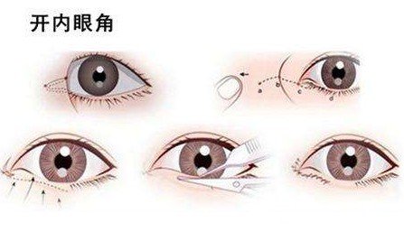 开外眼角前后对比图