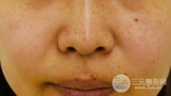 彩光去雀斑需要做几次?每次大概多少钱?