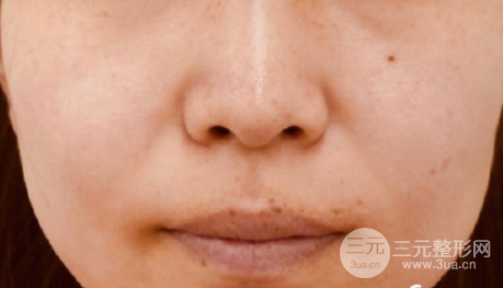 彩光去雀斑需要做几次