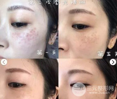 彩光去雀斑需要做几次