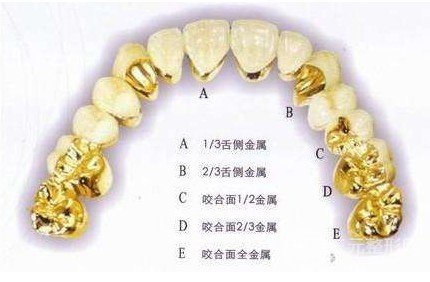 非贵金属烤瓷牙