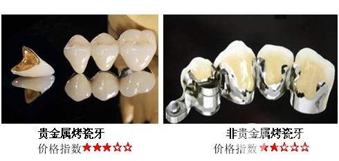 非贵金属烤瓷牙