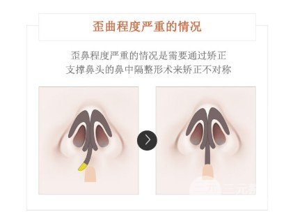 歪鼻矫正术价格