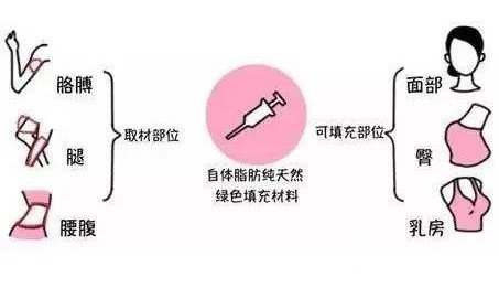 自体脂肪填充面颊价格多少