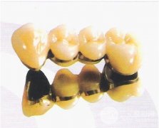 纳米烤瓷牙和全瓷牙哪个好？果+费用比较