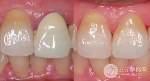 纳米烤瓷牙和全瓷牙哪个好