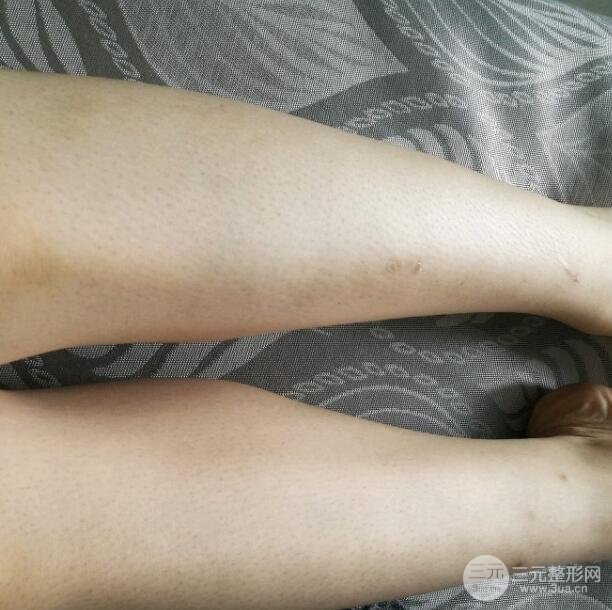 银川医院皮肤科脱毛5个月