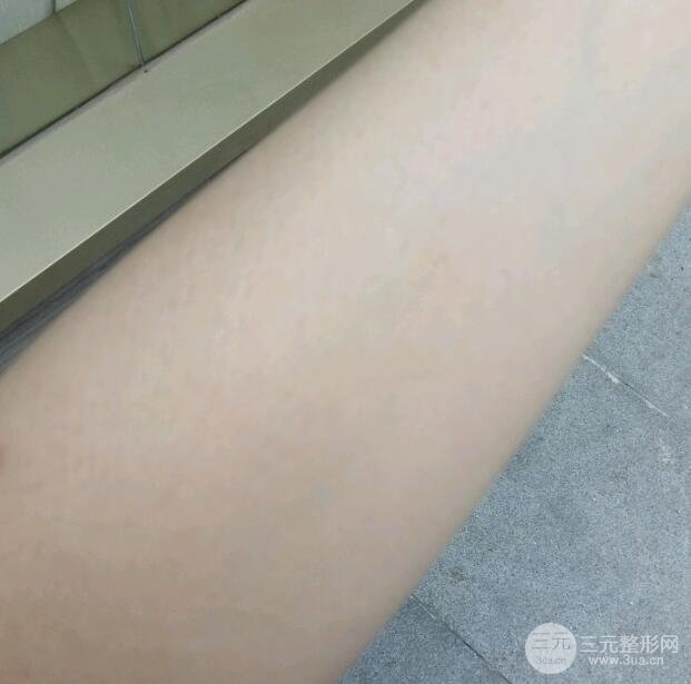 银川医院皮肤科脱毛5个月