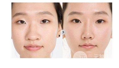 鼻翼肥大整形多少钱