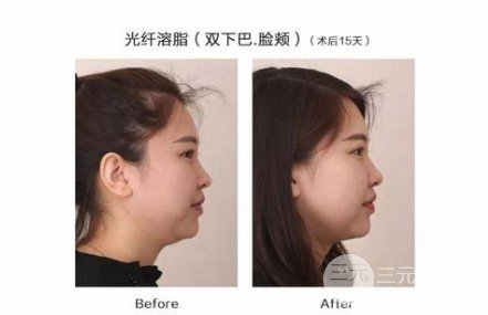 面部光纤溶脂有什么副作用吗