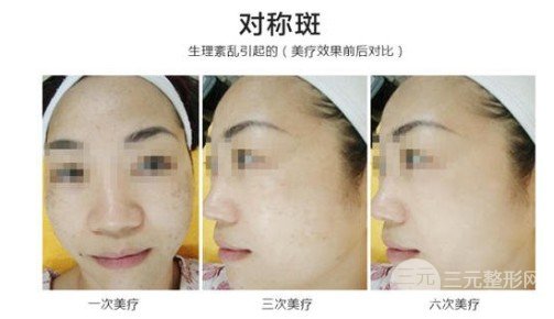 激光能去黄褐斑吗