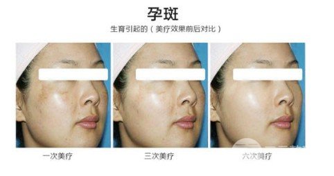 激光能去黄褐斑吗