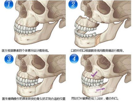 磨骨手术对比照片详解