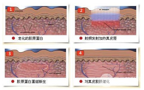 激光缓解黑眼圈有吗