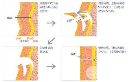 拉皮除皱术能保持几年