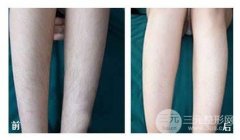 复合彩光脱毛有什么特点?手术原理和注意事项