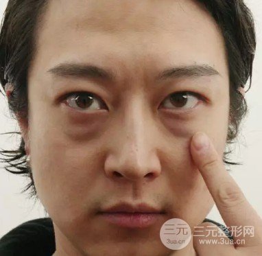 手术缓解眼袋怎么样