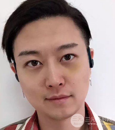 手术缓解眼袋怎么样