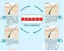 果酸焕肤价格公开，嫩肤祛痘竟然这么“白菜”！