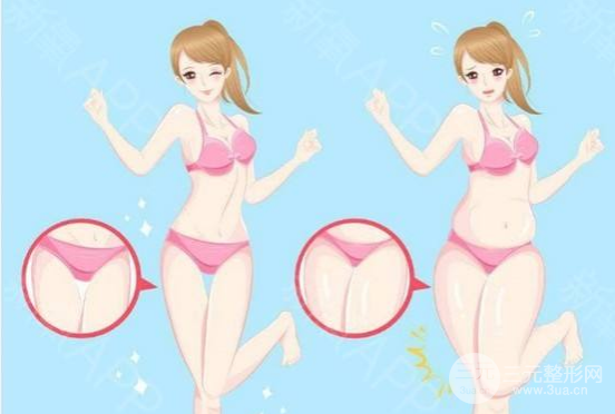 吸脂瘦大腿肿胀期是多久