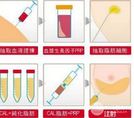 自体隆胸手术失败可以修复吗