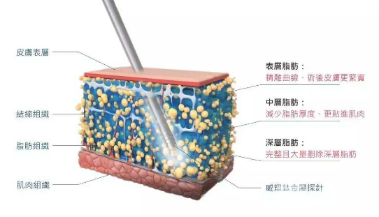 威塑吸脂原理