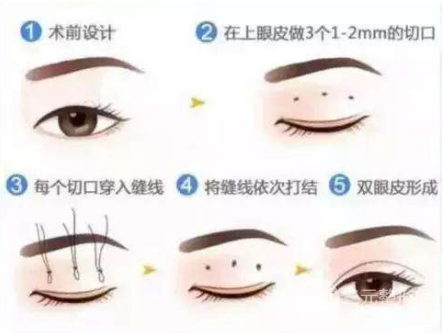 微创双眼皮多少钱