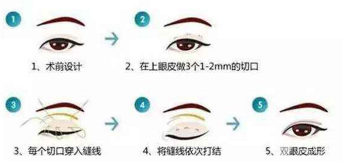 微创双眼皮多少钱