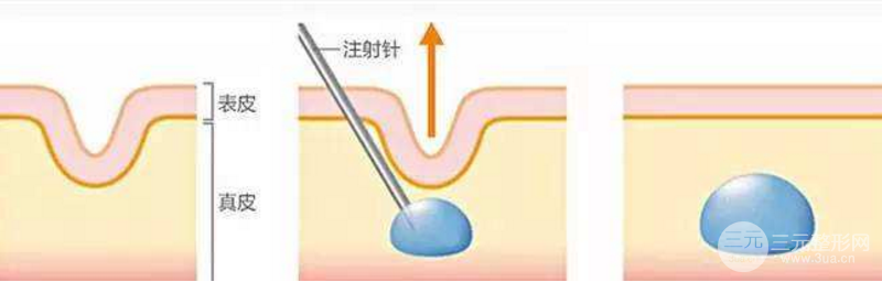 脸部哪些部位可以注射胶原蛋白美容