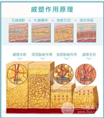 威塑抽脂和水动力吸脂区别