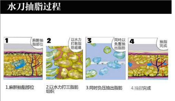 威塑抽脂和水动力吸脂区别