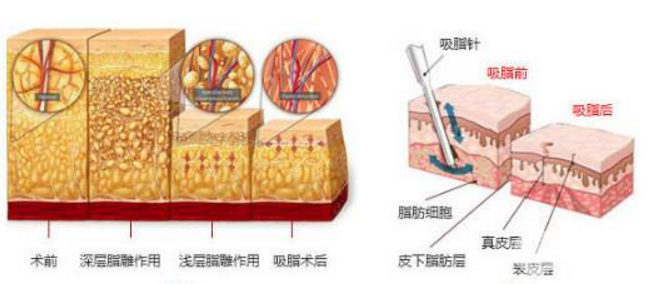 威塑抽脂和水动力吸脂区别