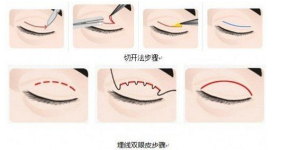 双眼皮埋线价格