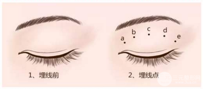 双眼皮埋线价格