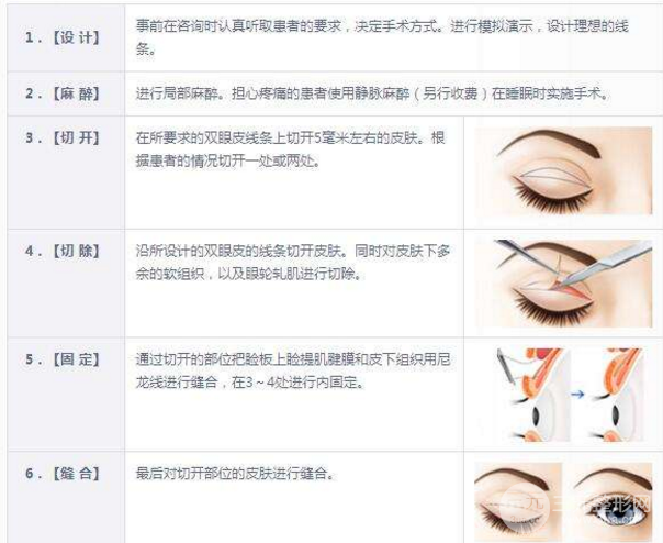 专业双眼皮手术术前注意事项