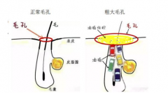 激光缓解毛孔粗大价格是多少？影响因素有哪些？