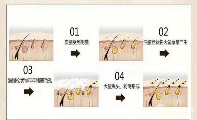 激光缓解毛孔粗大价格