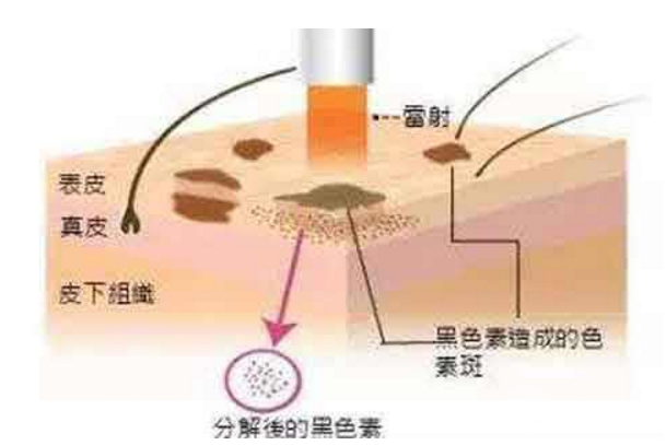 激光缓解毛孔粗大价格