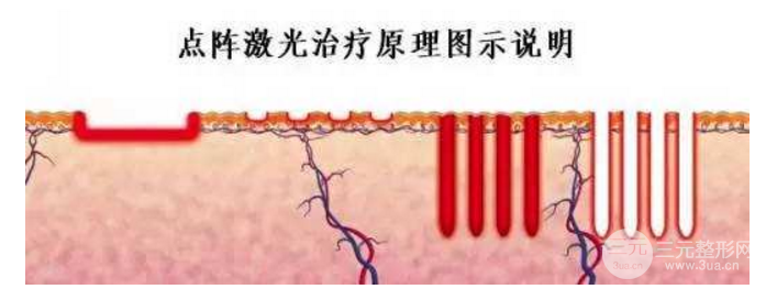 激光缓解毛孔粗大前需要注意的事项