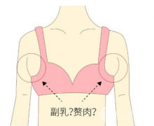 腋下副乳手术多少钱？腋下副乳手术注意事项有哪些？