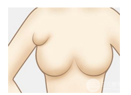 腋下副乳手术多少钱?