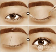 微创全切双眼皮的原理，术前术后注意事项都清楚了嘛？