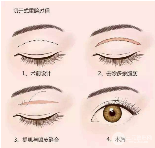 微创全切双眼皮前需要注意的事项