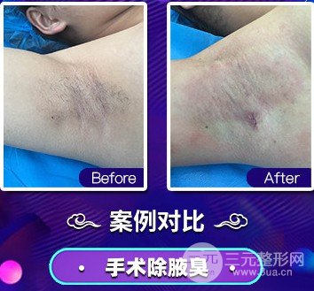 腋臭手术价格多少