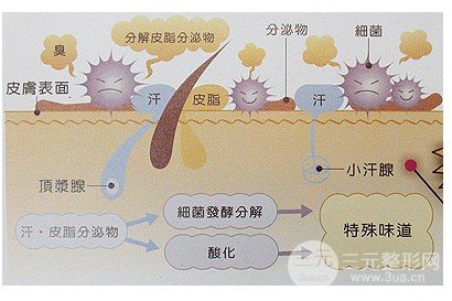 腋臭手术价格多少