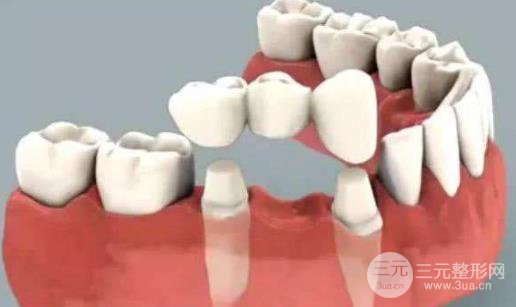 钴铬合金烤瓷牙价格贵吗